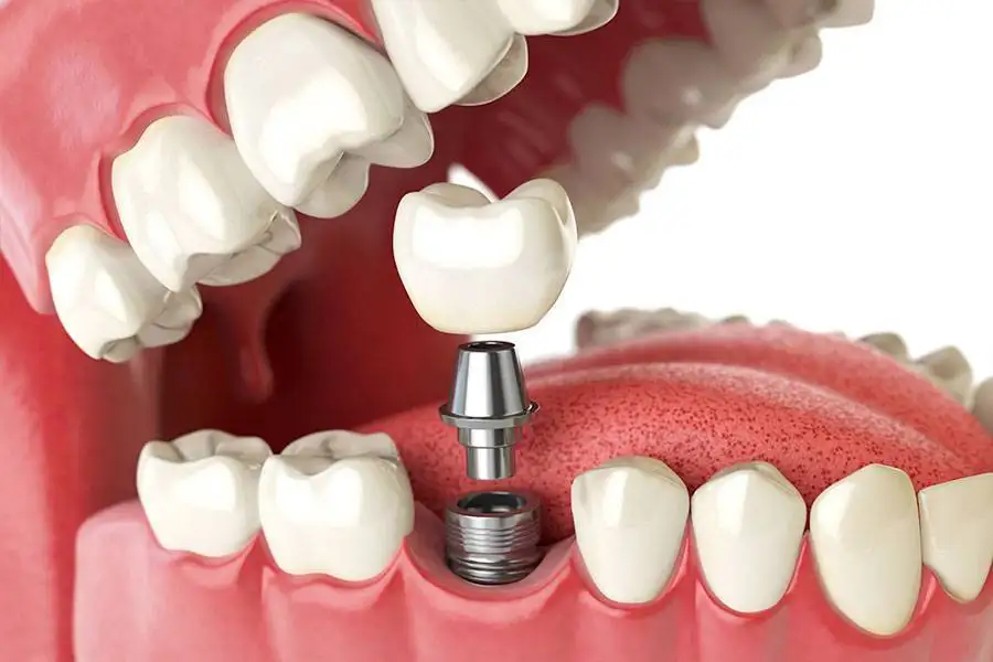 dental-implants dental-implants