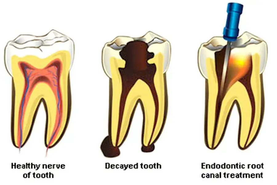 root-canal root-canal